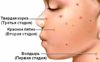 Сыпь при ветрянке, Коксаки и крапивнице: как их различить и чем помочь ребёнку