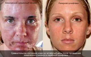 Пятна от прыщей — эффективные методы и схемы лечения. Советы дерматологов и рекомендации как правильно избавиться от последствий повреждения кожи (90 фото)